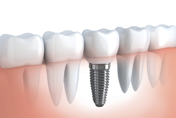 Implants