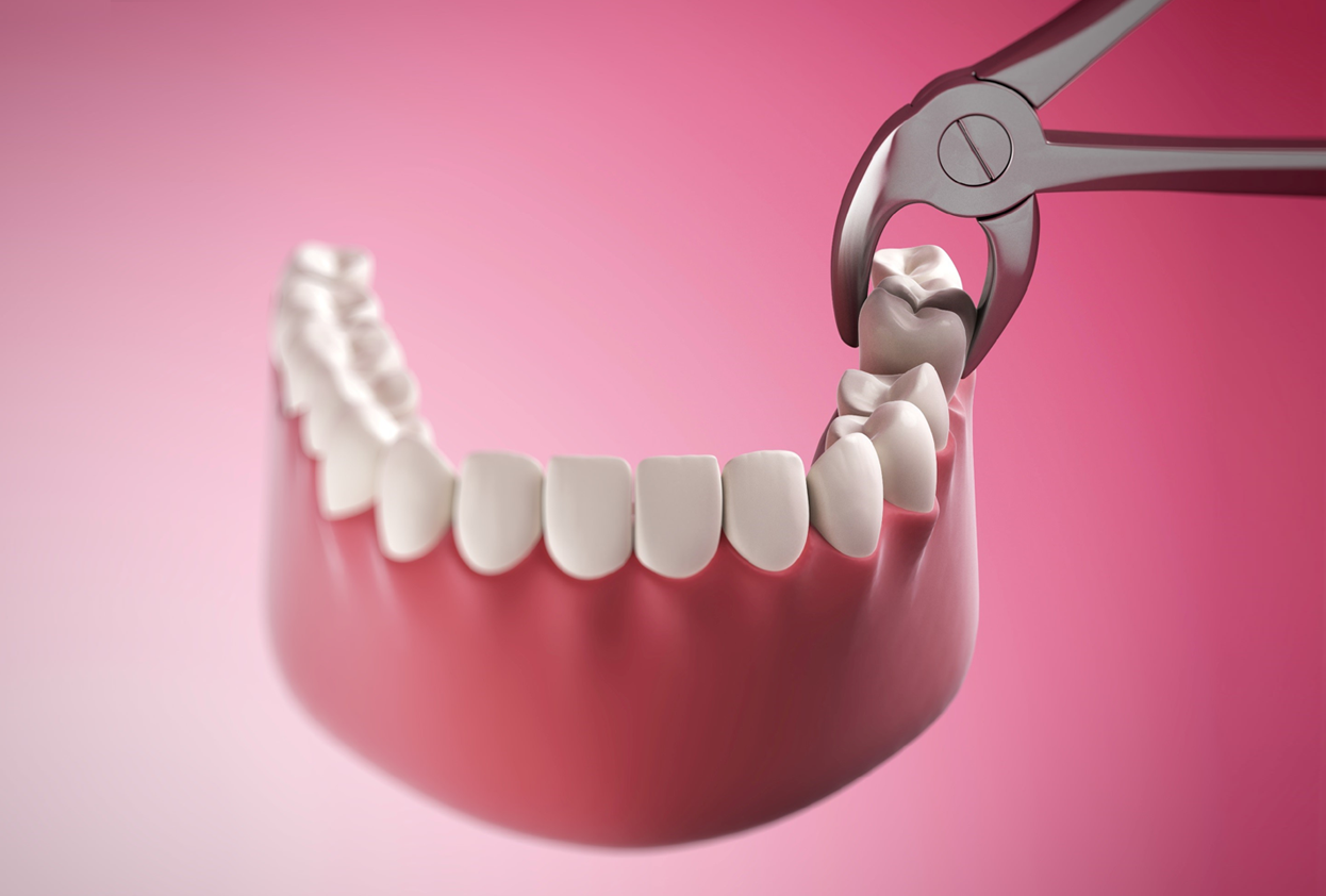 Extractions